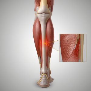 Night Muscle Cramps Causes